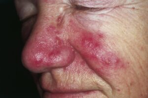 Read more about the article Rosacea Uncovered: Expert Tips for Managing Symptoms and Achieving Healthy Skin